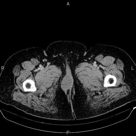 Bartholin Gland Cyst Mri