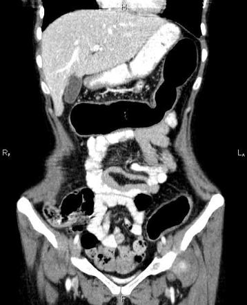 case study 28 ulcerative colitis