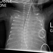 Viewing playlist: Neonatal CXR | Radiopaedia.org