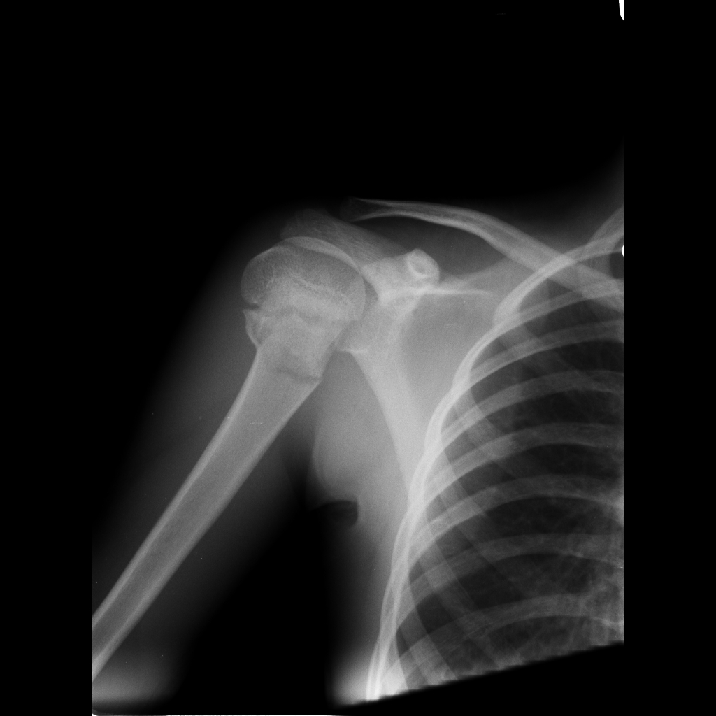 Mechanisms Of Humeral Head Fracture - Vrogue.co