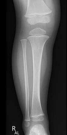 Toddler's fracture | Radiology Case | Radiopaedia.org