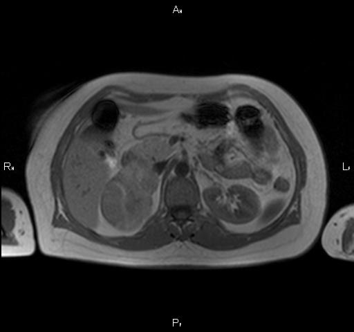 Bilateral adrenal myelolipoma | Image | Radiopaedia.org