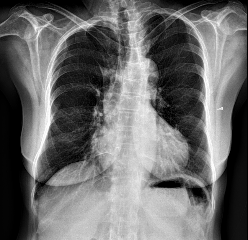 Pectus carinatum | Image | Radiopaedia.org