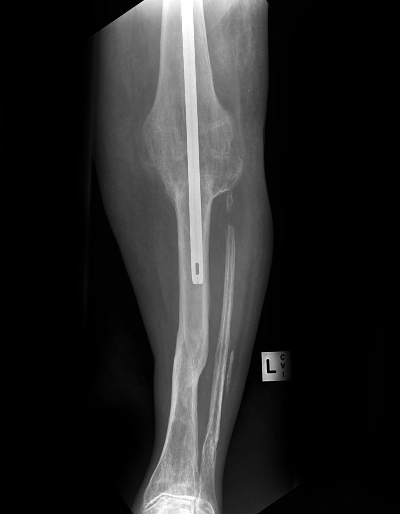 Minimally invasive treatment of forearm double fracture in adult using  Acumed forearm intramedullary nail: A case report