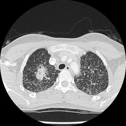 Non-small cell lung cancer with miliary metastases | Image