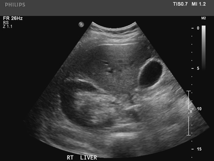 Crossed fused renal ectopia | Image | Radiopaedia.org