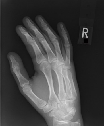 Fractures of 4th and 5th metacarpals | Radiology Case | Radiopaedia.org