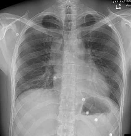 Superior mediastinum | Radiology Reference Article | Radiopaedia.org