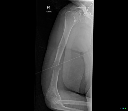 Humeral pathological fracture from metastasis treated with ...