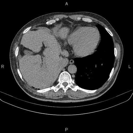 Diaphragmatic rupture and ductus diverticulum | Image | Radiopaedia.org