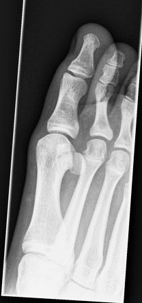 Bipartate sesamoid | Image | Radiopaedia.org