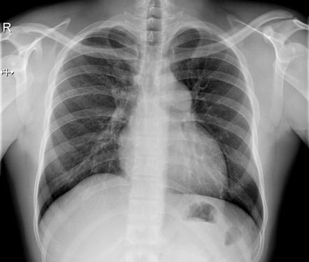 Subvalvular pulmonary stenosis | Radiology Case | Radiopaedia.org