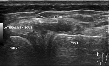 Parameniscal cyst and meniscal tear (ultrasound) | Radiology Case ...