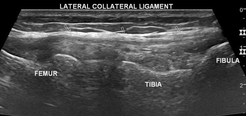 Parameniscal Cyst And Meniscal Tear Ultrasound Image 1203