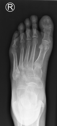 Osteomyelitis (interval imaging) | Radiology Case | Radiopaedia.org