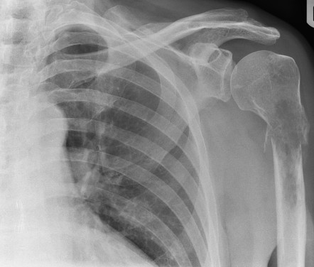 Pathological fracture of the humerus | Radiology Case | Radiopaedia.org