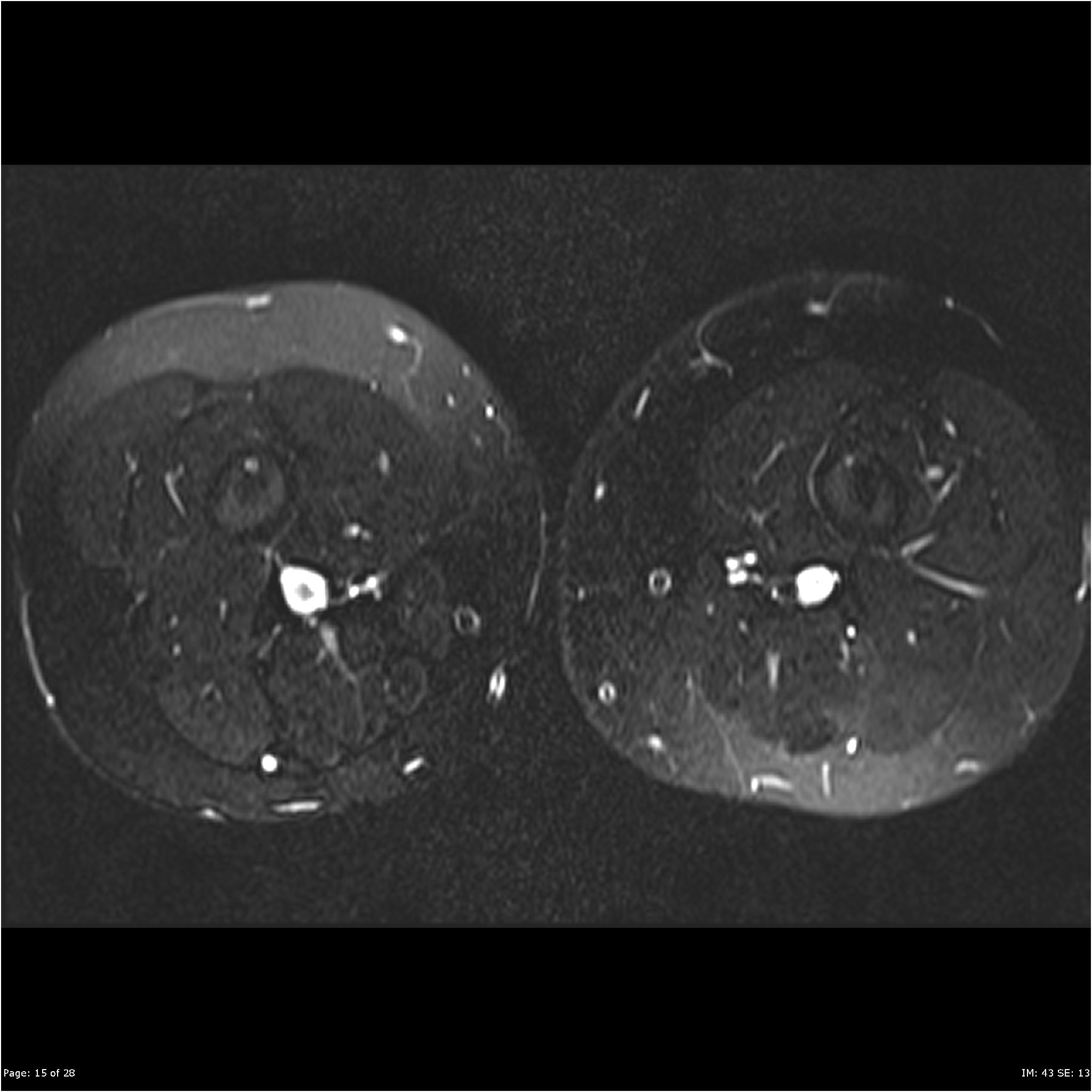 Congenital myopathy | Image | Radiopaedia.org