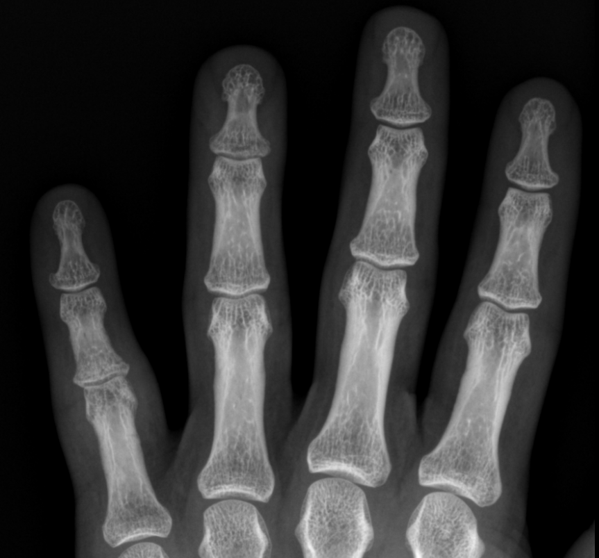 Mallet finger Image