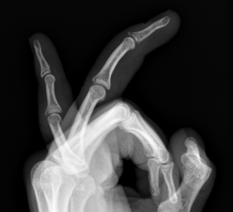 Mallet Finger X Ray Positioning at Miriam Ritchie blog