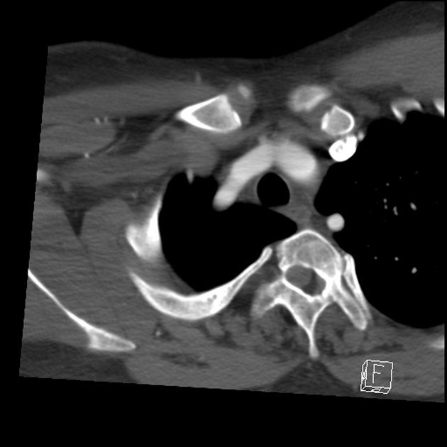 brachiocephalic vein