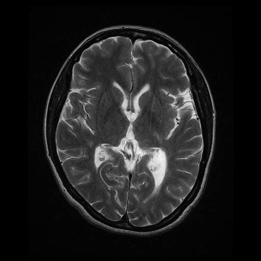 Wallerian degeneration in multiple sclerosis | Image | Radiopaedia.org