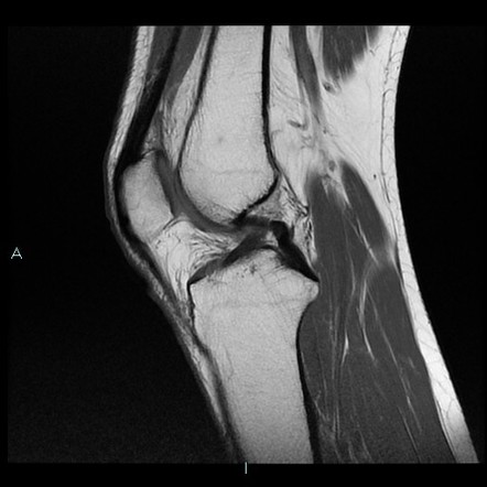 Localized pigmented villonodular synovitis | Image | Radiopaedia.org