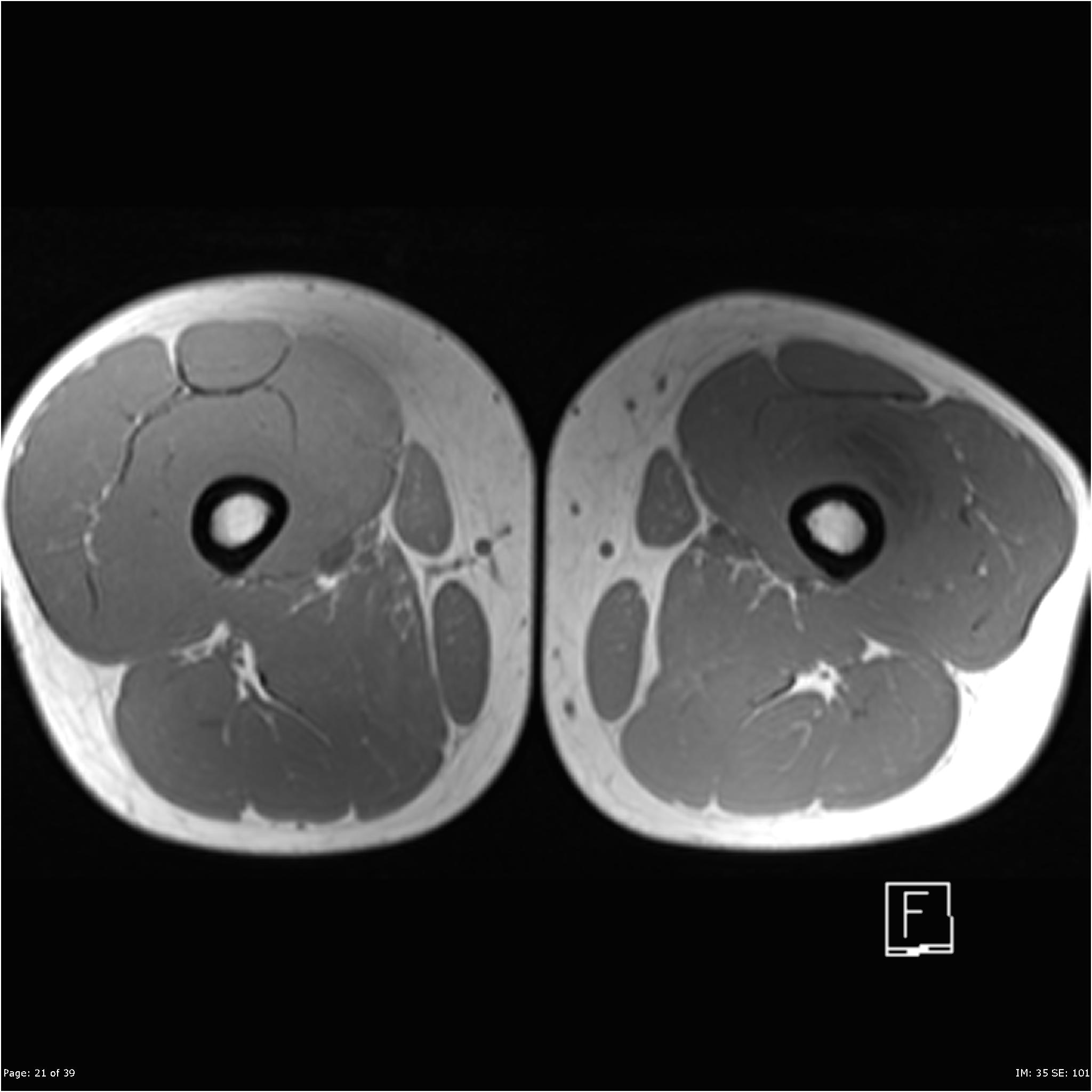 Myositis Ossificans Ultrasound