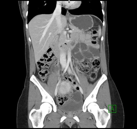 Broad ligament hernia | Image | Radiopaedia.org