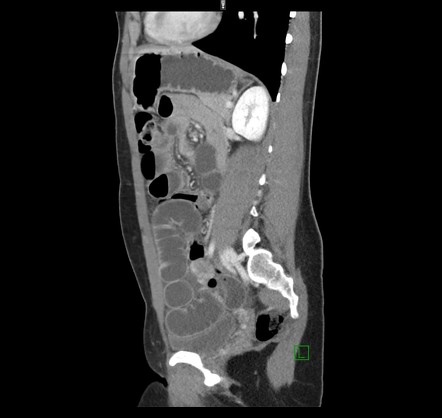 Internal hernia | Radiology Reference Article | Radiopaedia.org