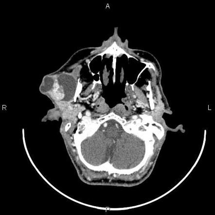 Tumor De Warthin