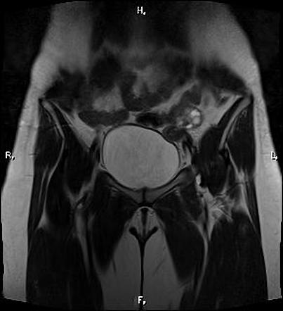 Mayer-rokitansky-küster-hauser Syndrome 