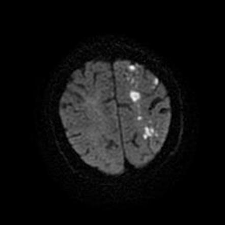 Watershed cerebral infarction | Radiology Case | Radiopaedia.org