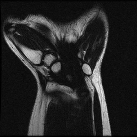 Carpal tunnel syndrome (MRI) | Image | Radiopaedia.org