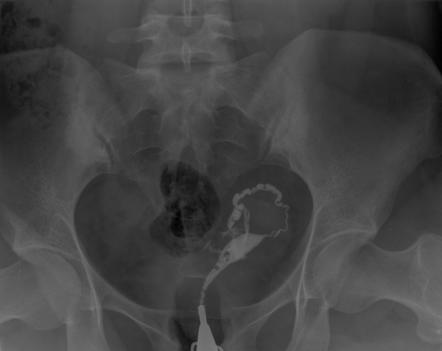 Unicornuate uterus | Radiology Case | Radiopaedia.org