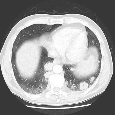 Angioinvasive aspergillosis | Radiology Reference Article | Radiopaedia.org