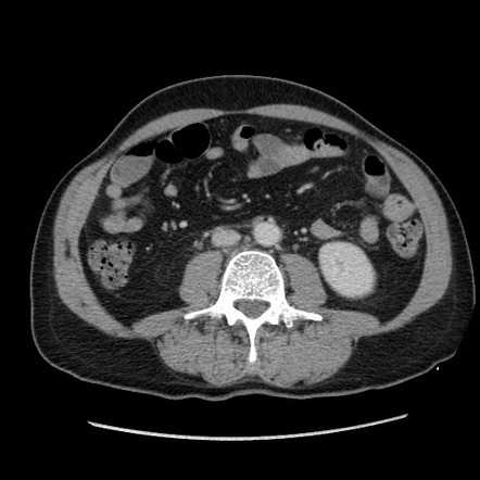 Secondary pulmonary lymphoma | Image | Radiopaedia.org