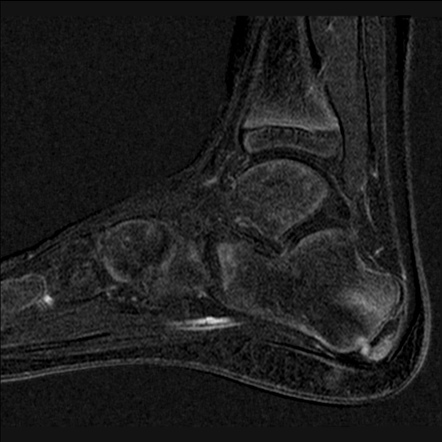 Calcaneal apophysitis - Sever disease | Image | Radiopaedia.org