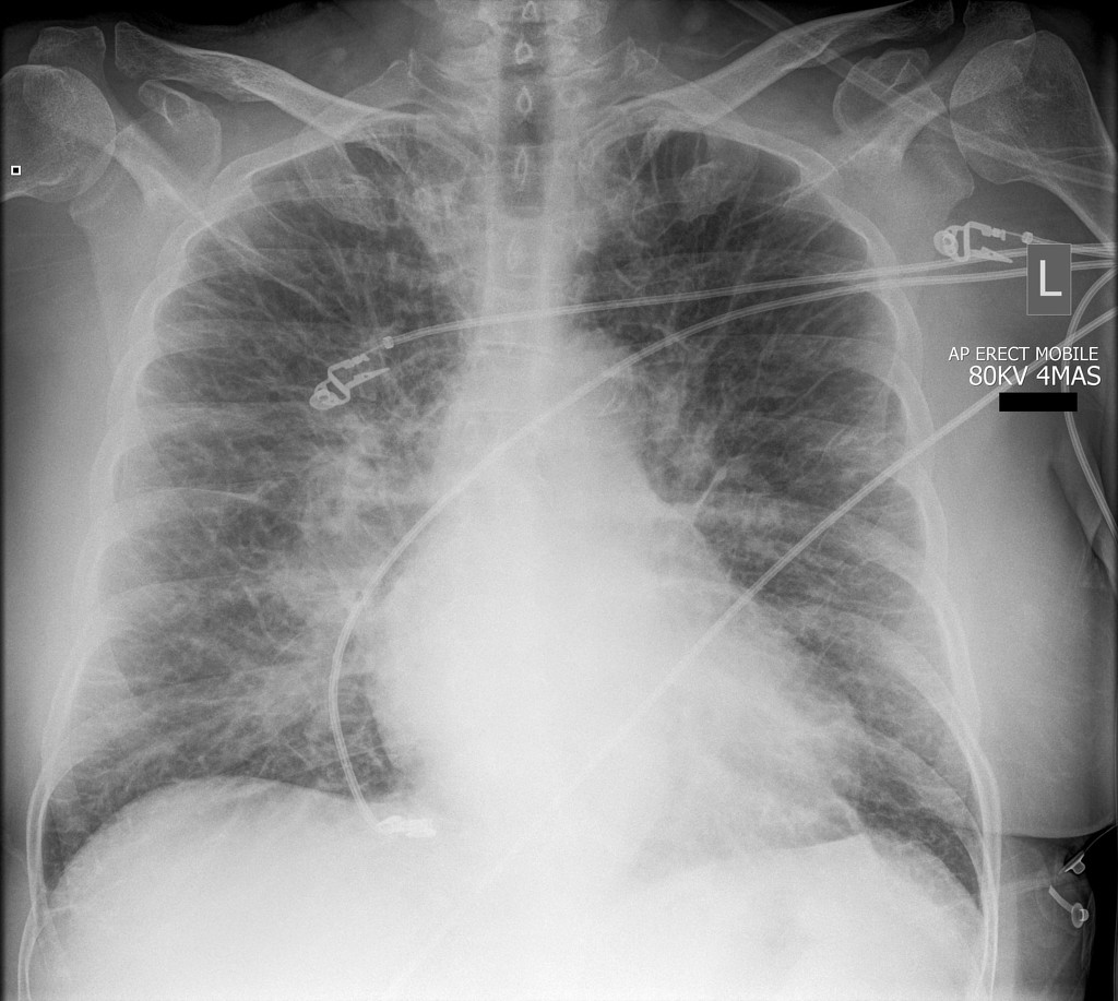 pulmonary edema chest x ray