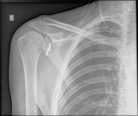 Latarjet procedure | Radiology Case | Radiopaedia.org