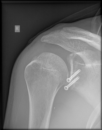 Latarjet procedure | Radiology Reference Article | Radiopaedia.org