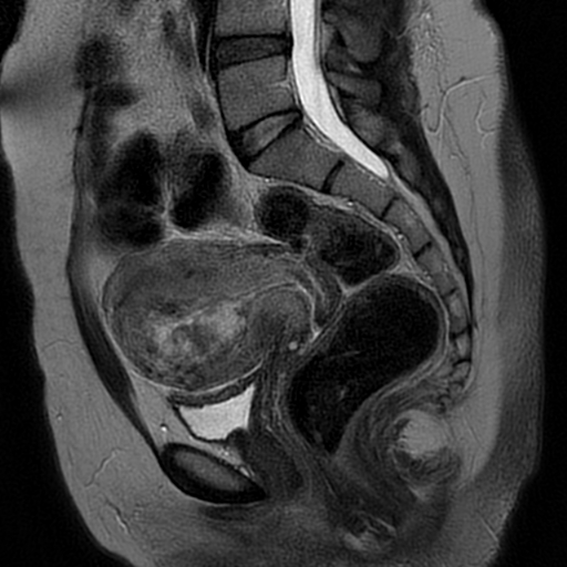 Uterine Arteriovenous Malformation Image