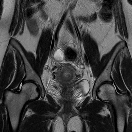 Uterine Arteriovenous Malformation Image Radiopaedia Org