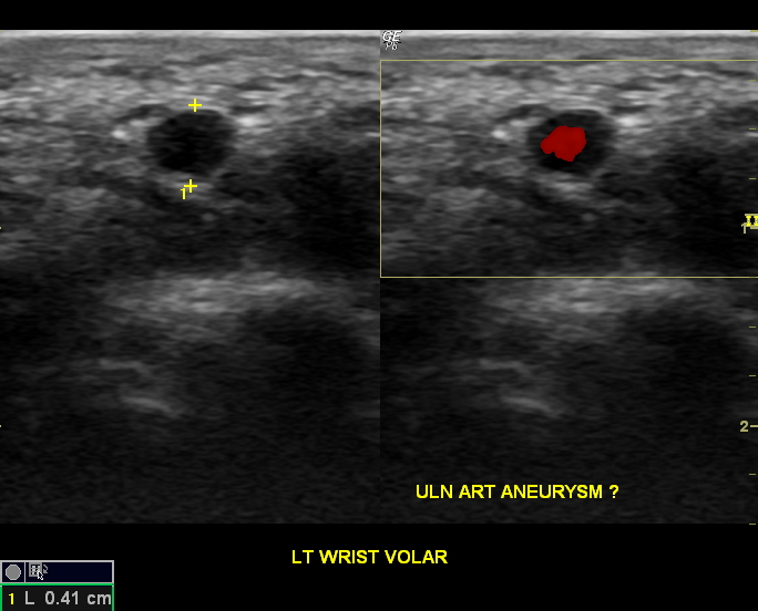 Ulnar artery aneurysm - fusiform | Image | Radiopaedia.org