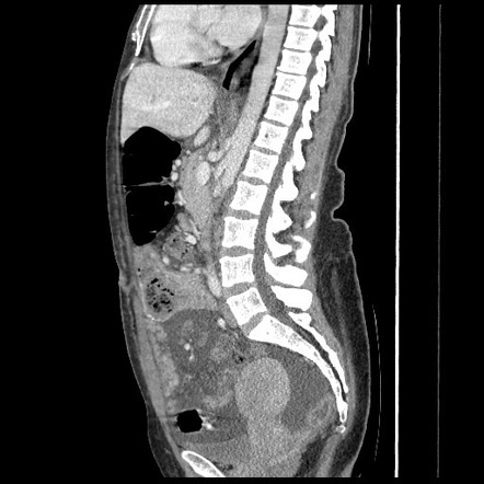 Post gastric bypass transmesenteric internal hernia | Image ...