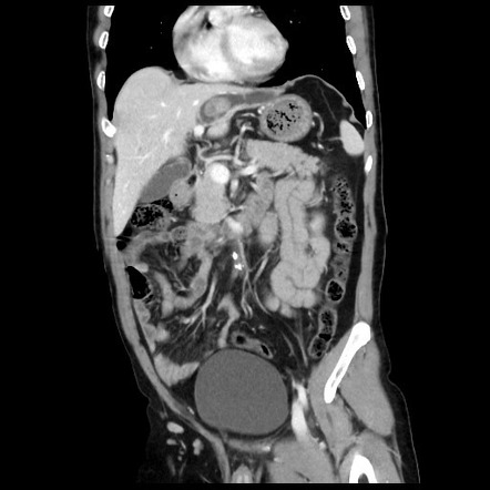 Hepatolithiasis | Radiology Reference Article | Radiopaedia.org