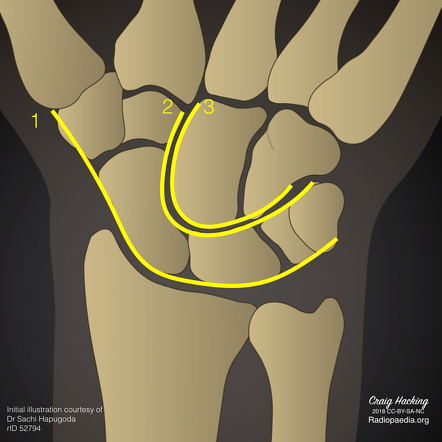 Gilula carpal arcs (diagram) | Radiology Case | Radiopaedia.org