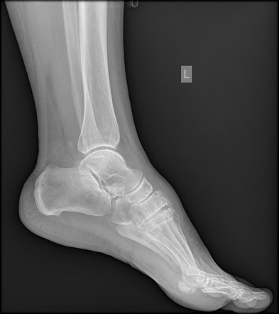 Anterior calcaneal process fracture | Image | Radiopaedia.org