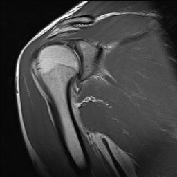 Superior Labral Anterior Posterior (SLAP) Tear | Image | Radiopaedia.org