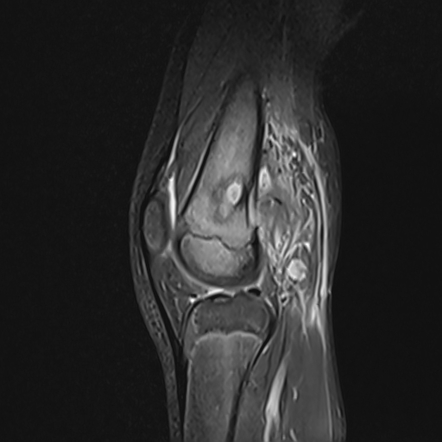 Femur osteomyelitis and abscess | Radiology Case | Radiopaedia.org