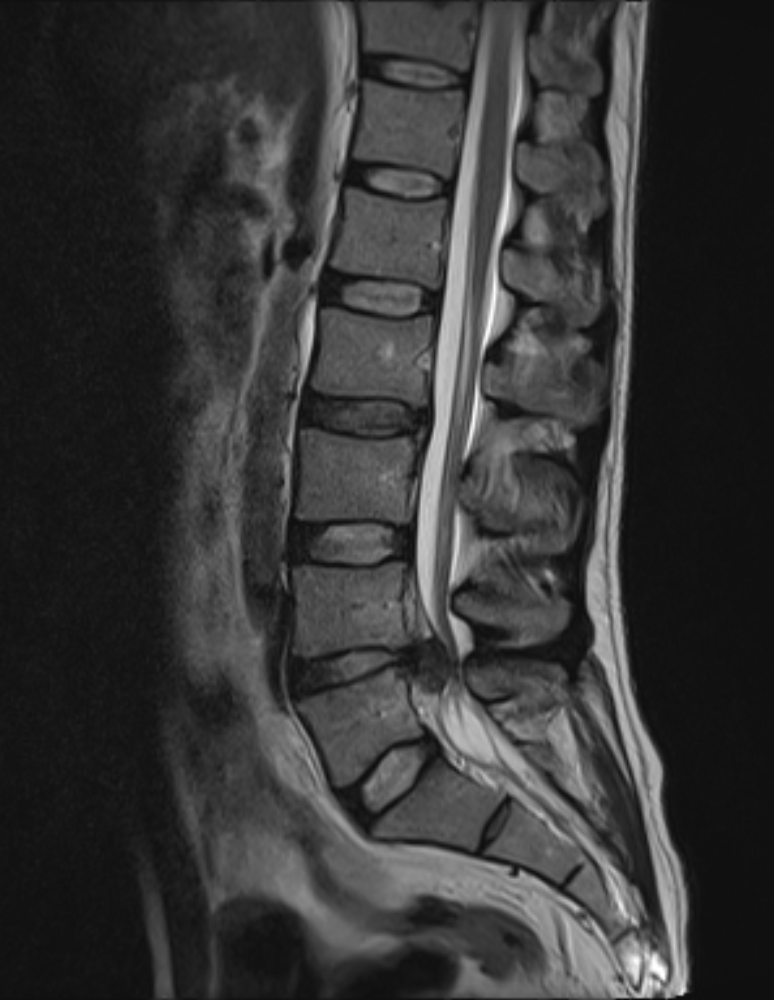 Disc extrusion | Image | Radiopaedia.org